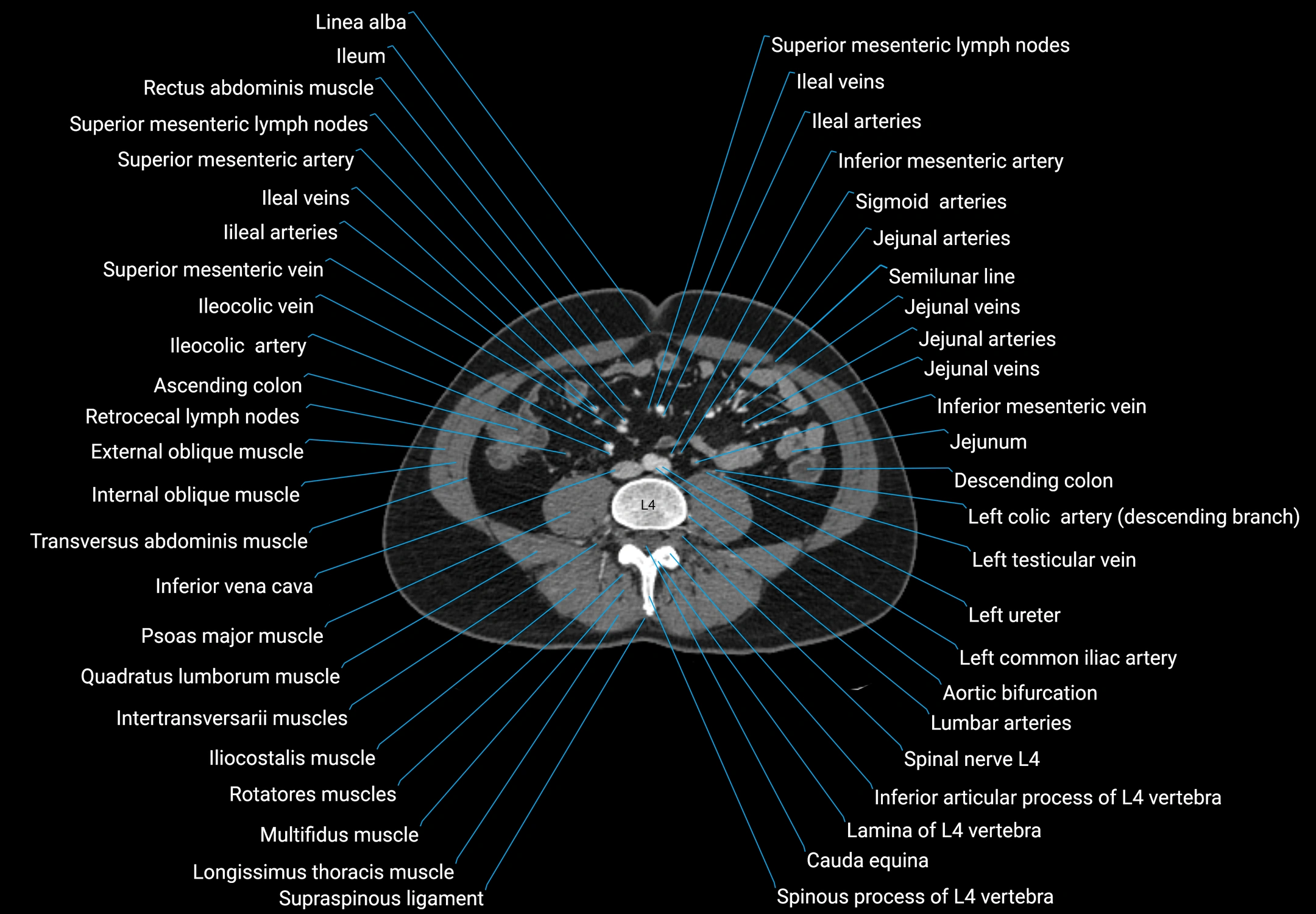 CT male pelvis axial cross sectional anatomy labelled radiology image -00112.webp